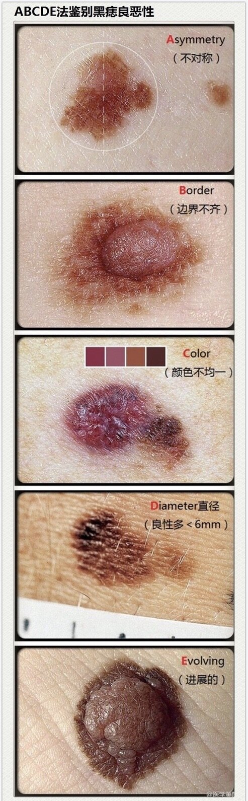 黑色素瘤的征兆 初期图片