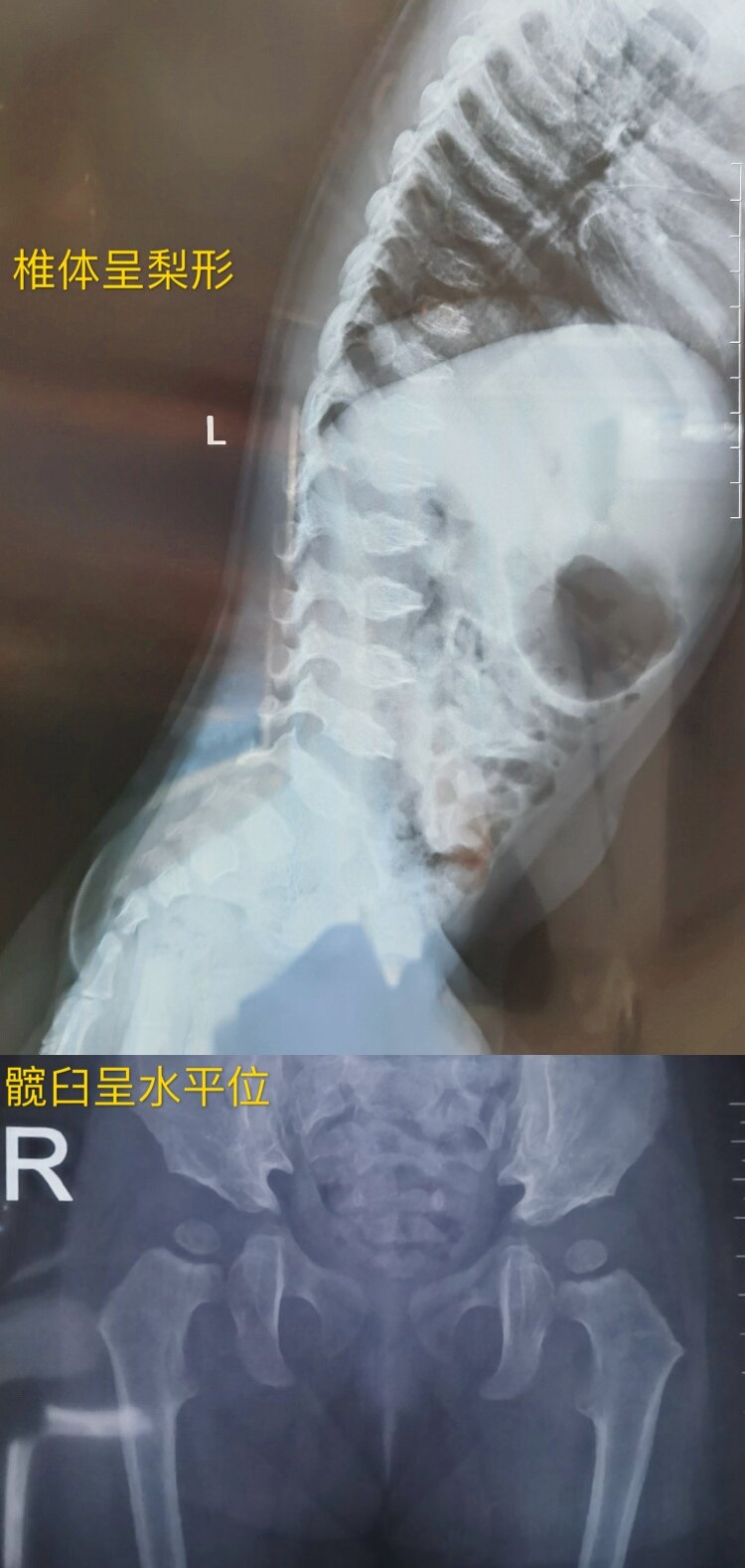 脊椎骨骺发育不良
