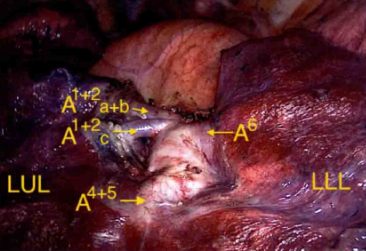 左肺上叶s12切除术
