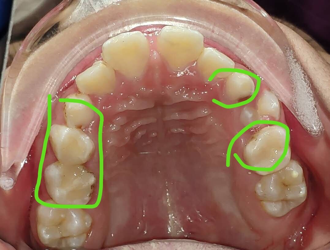 等到十二歲換完牙齒再進行正畸治療(有一點需要提一下,十二歲後矯治