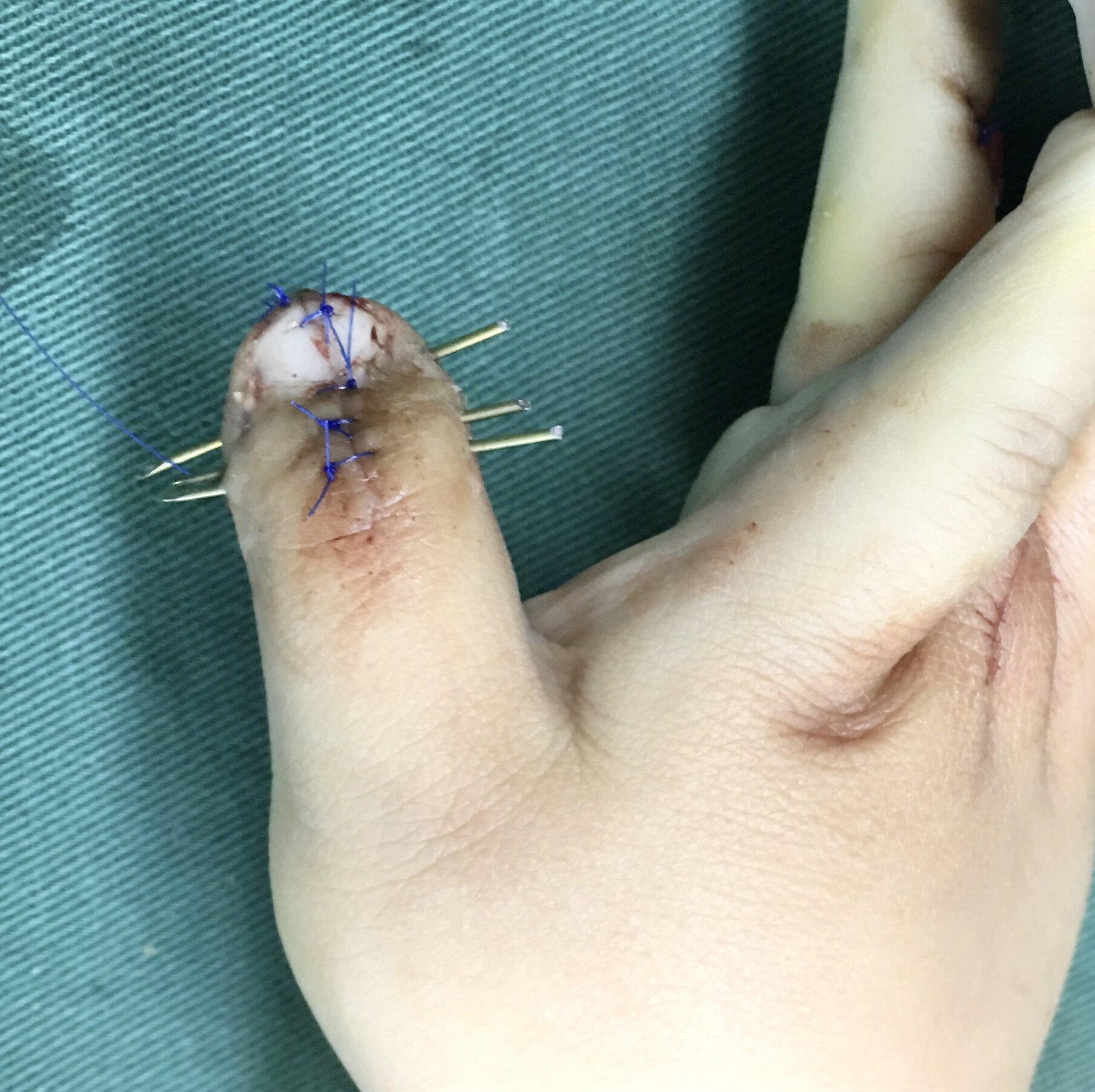 拇指多指畸形之一镜像拇—b-c手术_多指畸形_多指畸形治疗方式 - 好