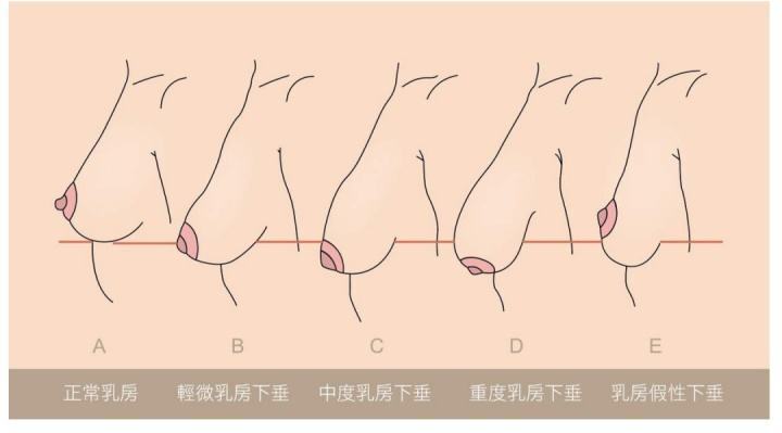 乳房下垂示意图.jpg