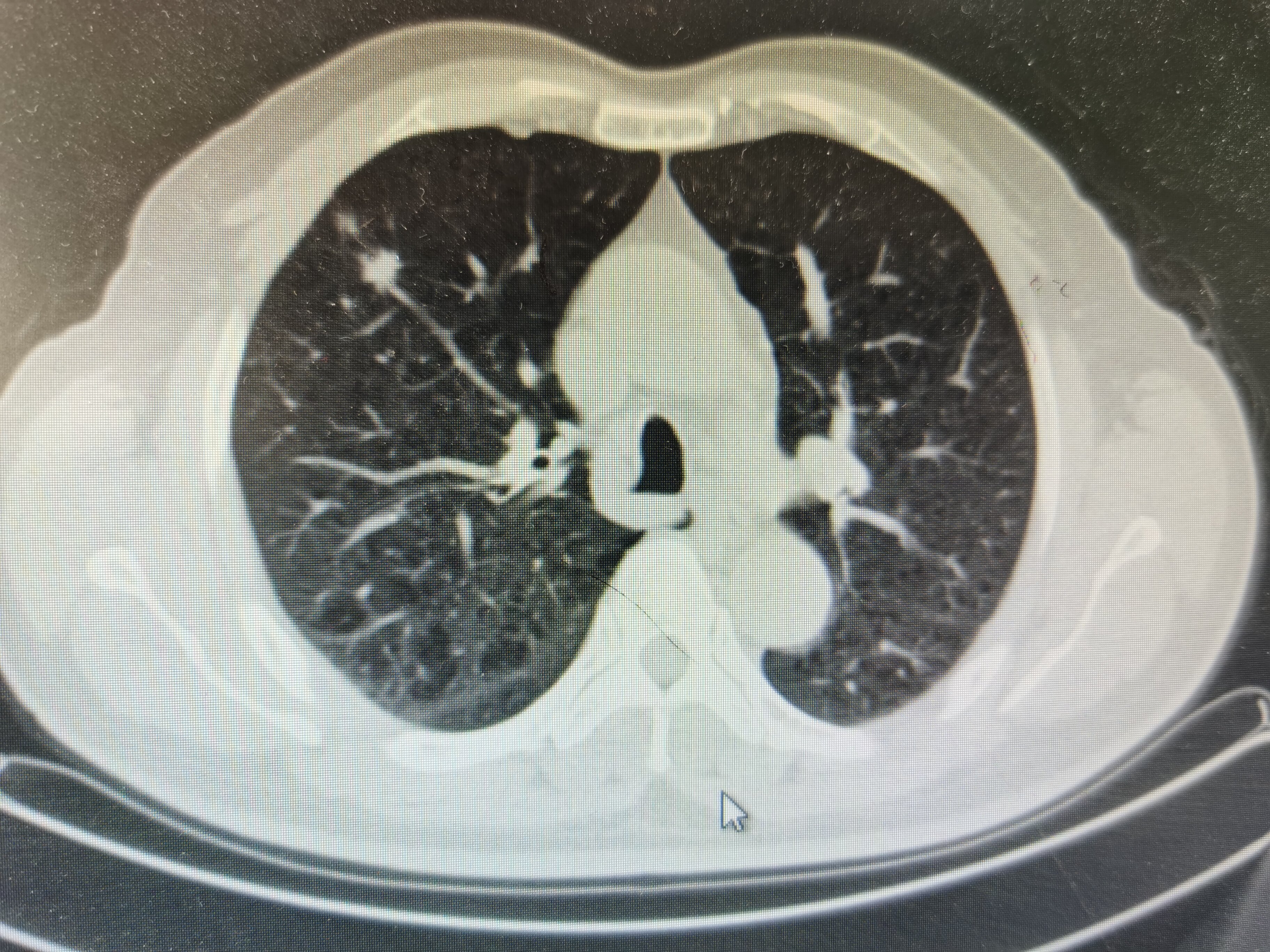 肺有结节怎么办 肺有结节怎么办