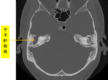 中耳炎ct影像表现图片图片
