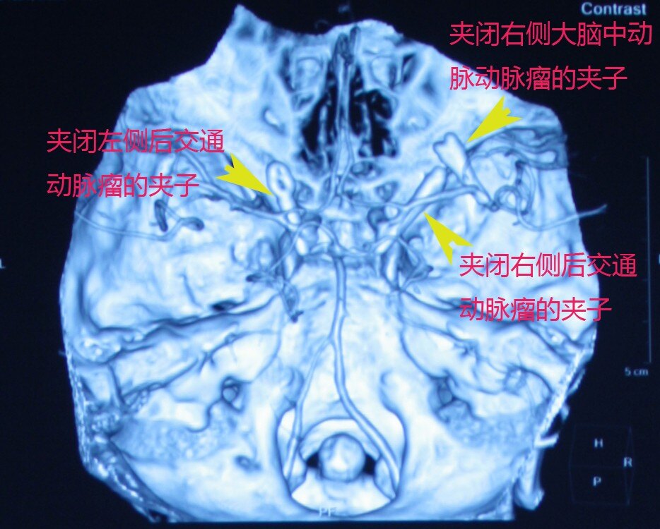 三个动脉瘤，术后.jpg