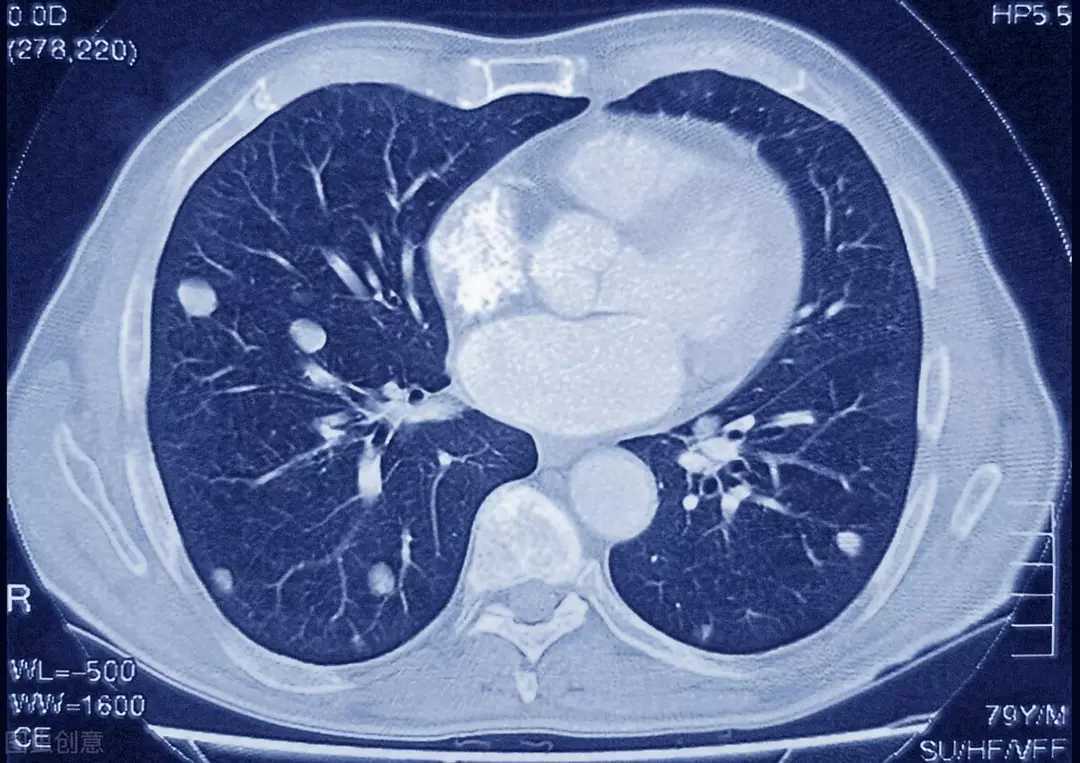 双肺多发微小结节产生原因及处理策略_肺部结节_肺部结节相关疾病