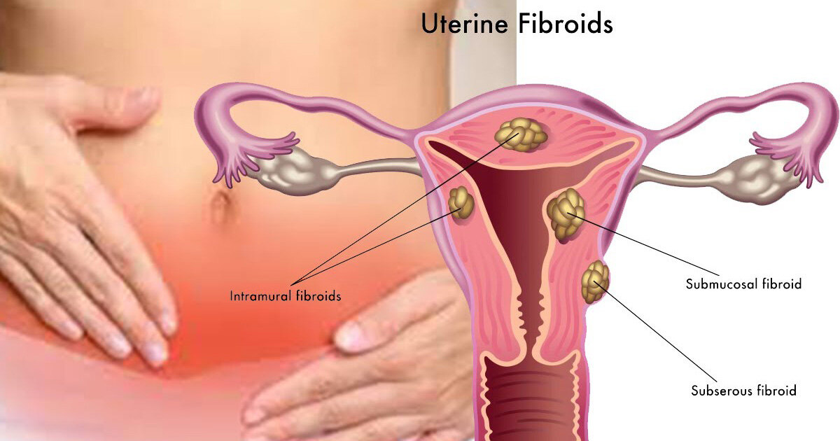 uterine-fibroids-fb.jpg