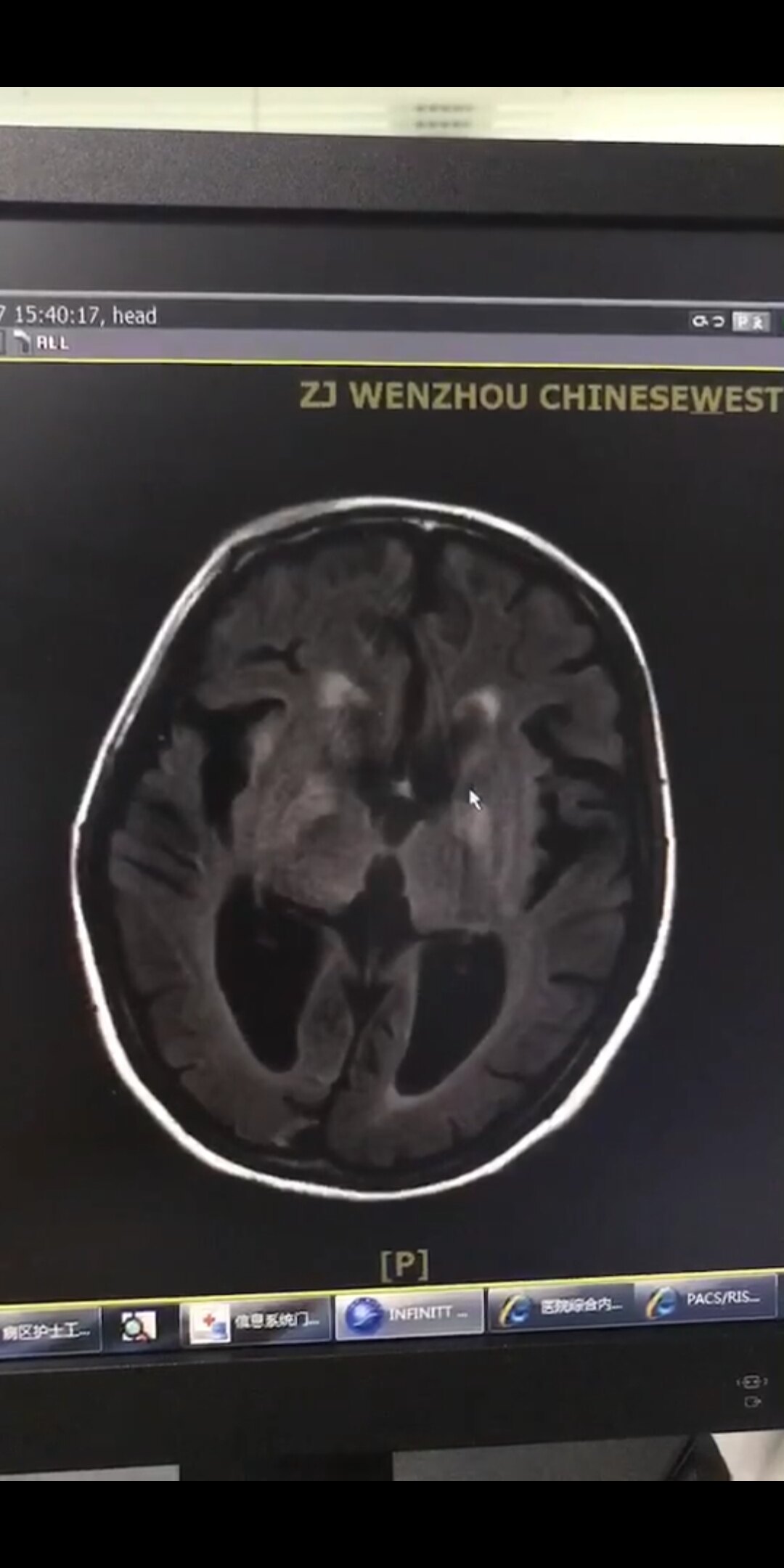 昏迷患者脑电图从重度到轻度异常历时两个月 - 好大夫在线