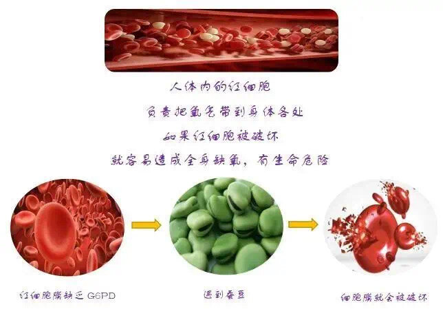 一吃蚕豆就发病 一文了解蚕豆病用药禁忌 溶血性贫血