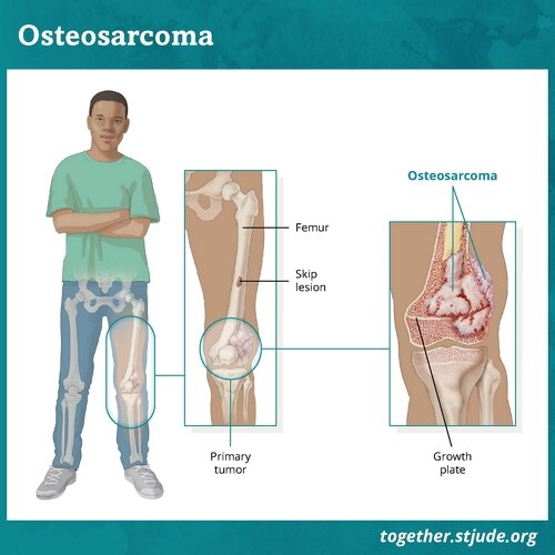 K01003-TOG-Osteosarcoma.webp.jpg