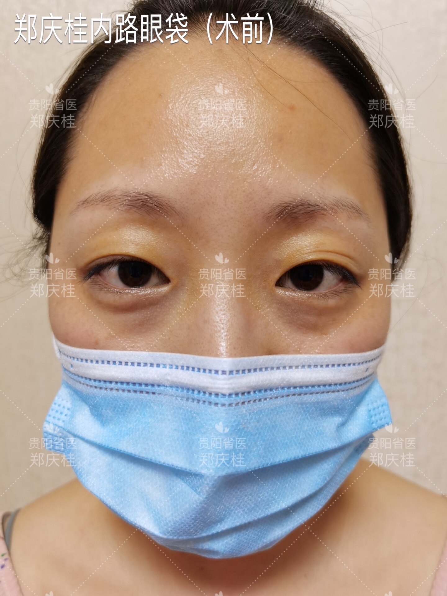 内路眼袋_去眼袋_去眼袋治疗介绍 - 好大夫在线