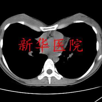 成人漏斗胸微創手術系列4女性重度漏斗胸