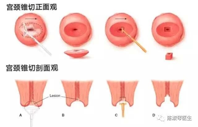 宮頸錐切到底是怎麼一回事