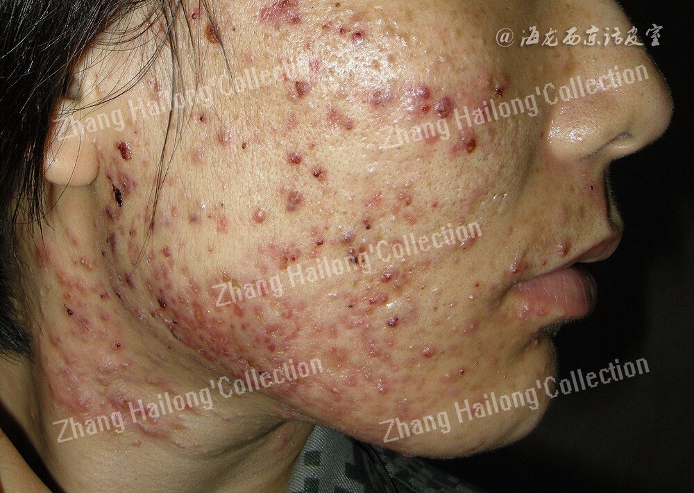 痤疮发病机制最新研究进展_痤疮_痤疮发病原因 - 好大夫在线