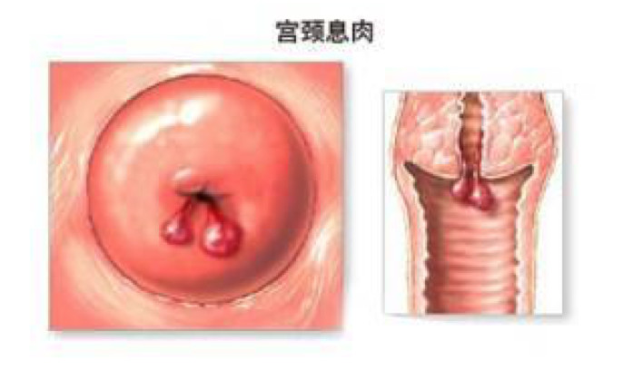 陰道反覆撕裂傷之後會長出來息肉嗎