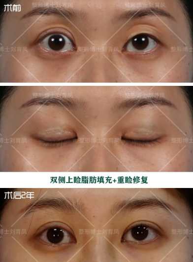 双眼皮修复十问十答 双眼皮修复
