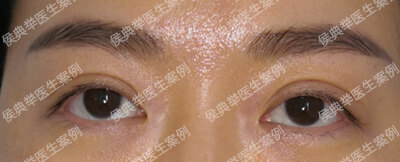 双眼皮失败的十种表现 下 双眼皮手术 双眼皮手术