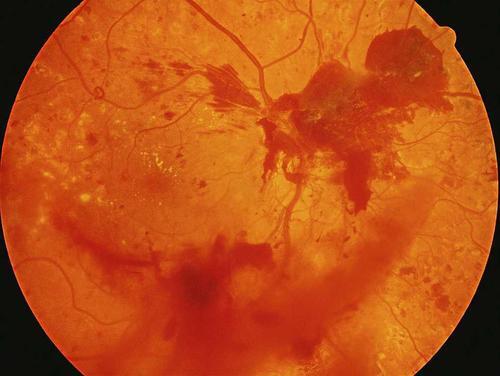 糖尿病防治指南及糖网病防治指南都强调眼底检查对防治糖网的重要性