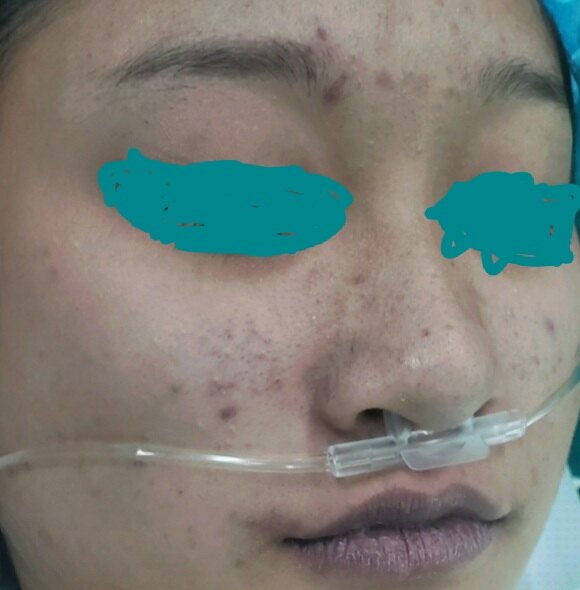 面色青紫手指及脚趾紫色,长期缺氧导致呈杵状指(趾)这种疾病在发病的