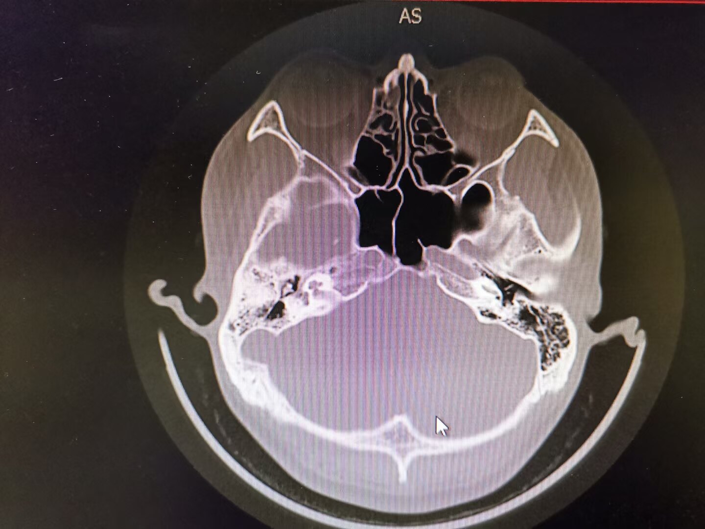 慢性化膿性中耳炎鼓膜穿孔耳內鏡下手術治療