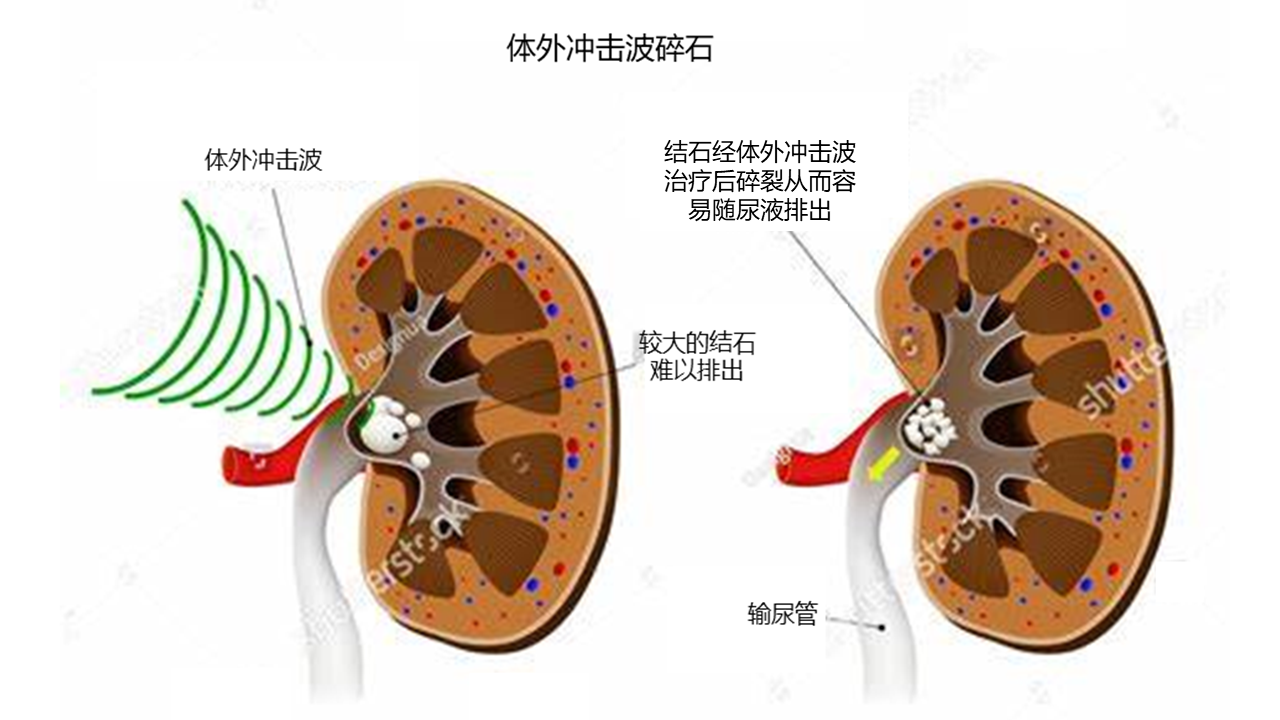 体外冲击波碎石 