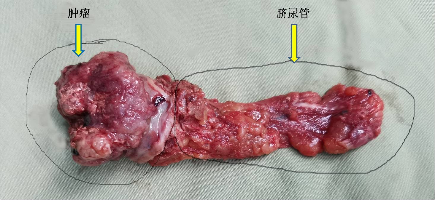 女性脐尿管囊肿手术图片