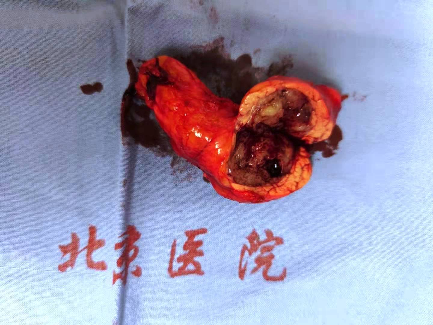 胰腺實性假乳頭狀瘤長什麼樣可不可以微創手術切除能不能保留脾臟