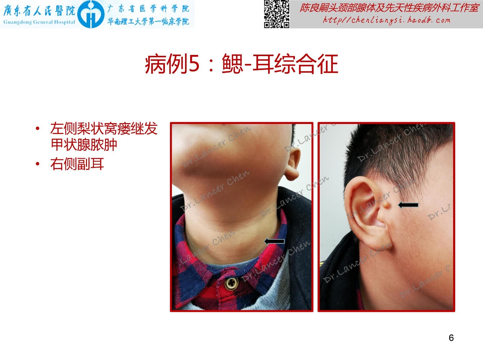 医学科普 易被疏忽的鳃 耳 肾综合征 医学科普 易被疏忽的鳃 耳 肾综合征