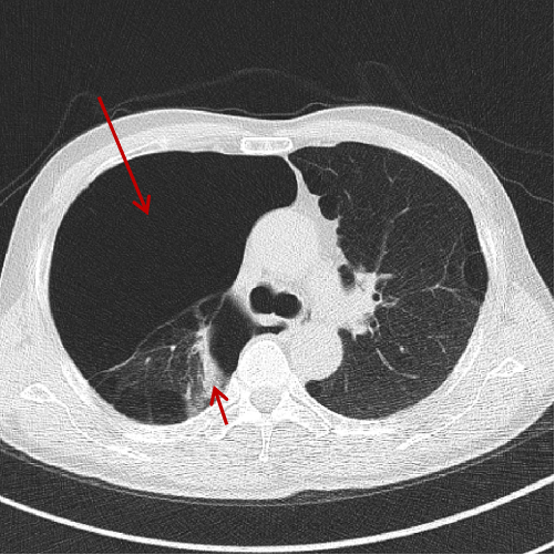 肺大疱图片怎么看图片