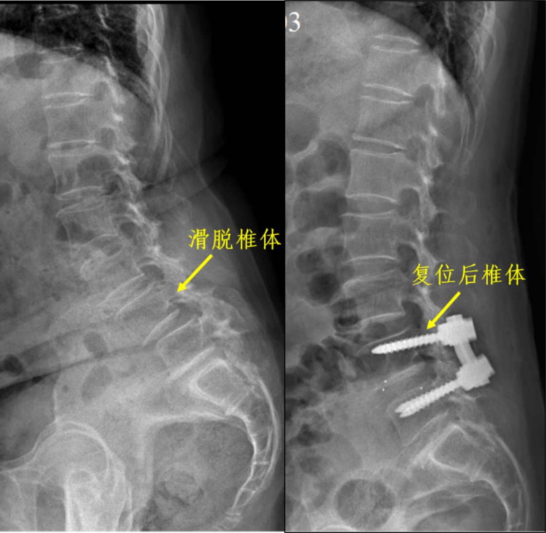 腰椎滑脱手术过程图片图片