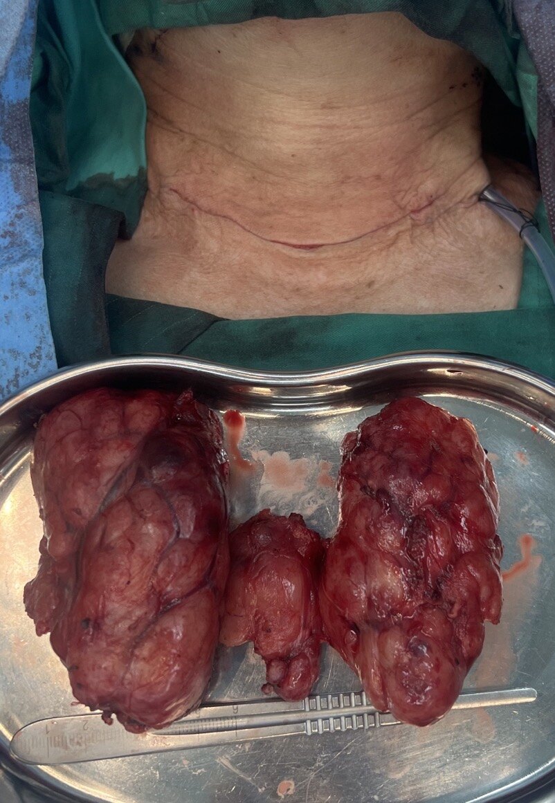 10厘米巨大甲状腺肿,形似盾甲