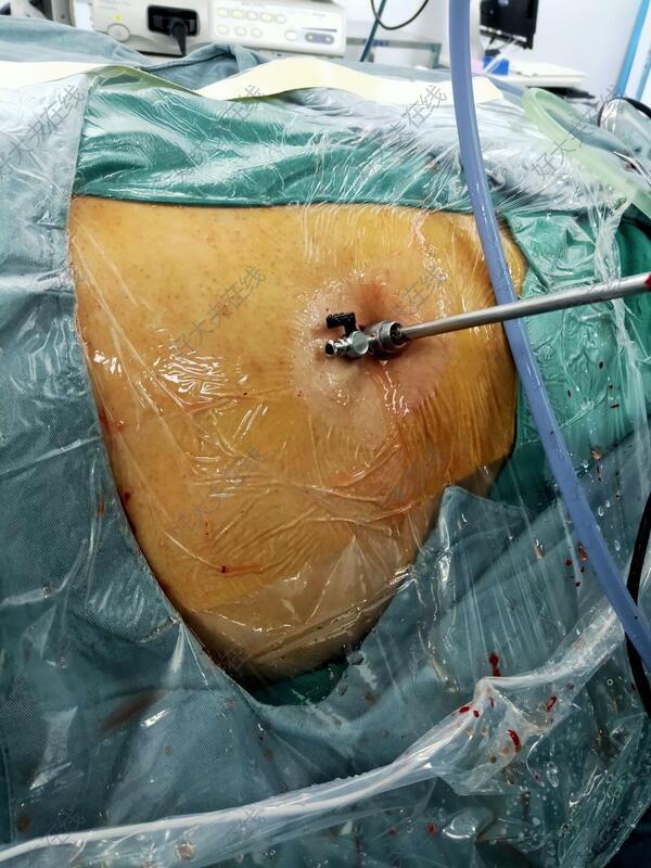 肾结石图片 激光手术图片