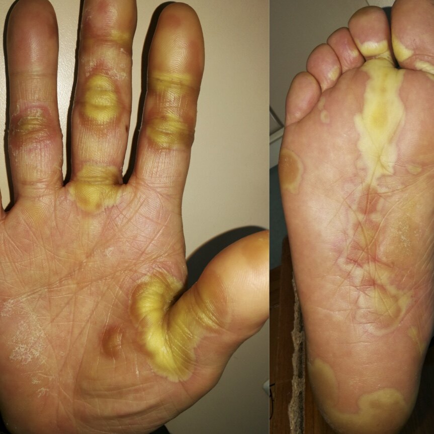 肿瘤靶向药可能会引起皮肤不良反应?不要慌快来看一看!