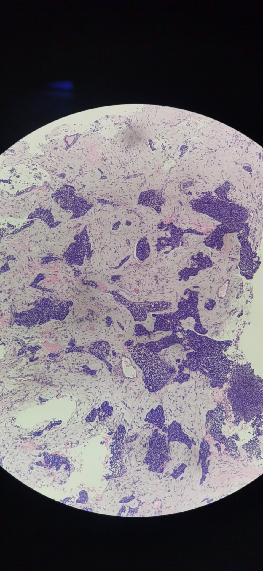 一例特殊的腺样囊性癌,实体型—免疫组化证实myb强阳性 - 好大夫在线