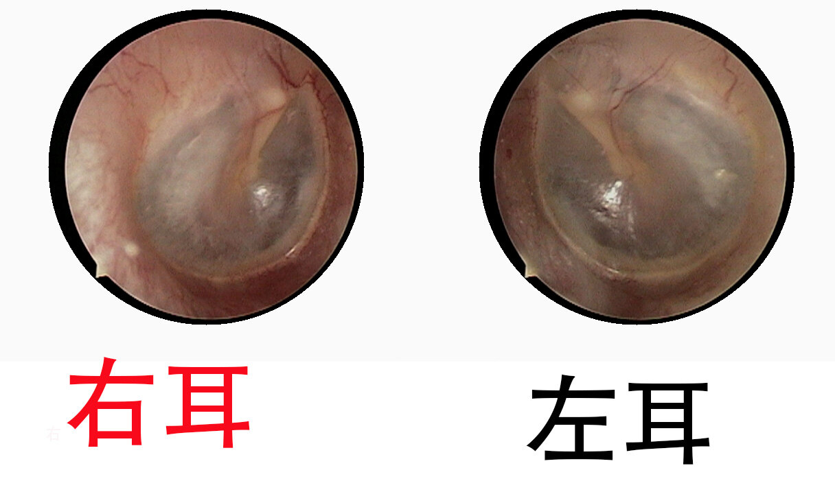 鼓膜穿孔怎麼辦要不要手術