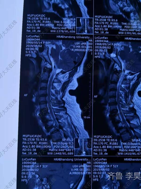 加重伴下肢活動障礙18天入院,當地醫院磁共振示多階段頸椎管狹窄,頸胸