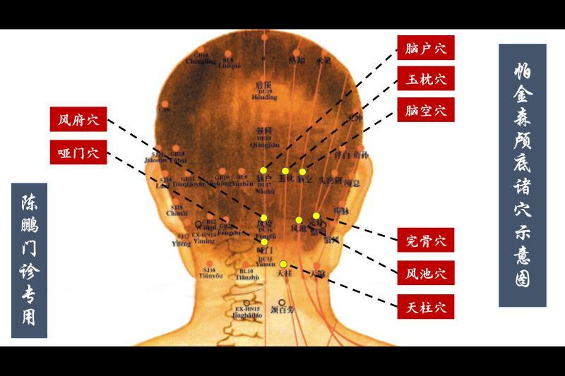 帕金森病的家庭穴位按摩五