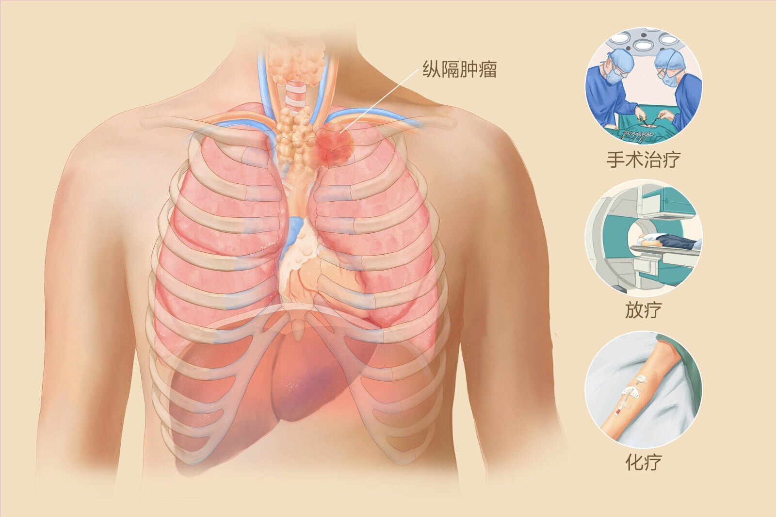 縱隔腫瘤知多少