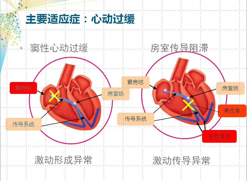 儿童起搏器那些事