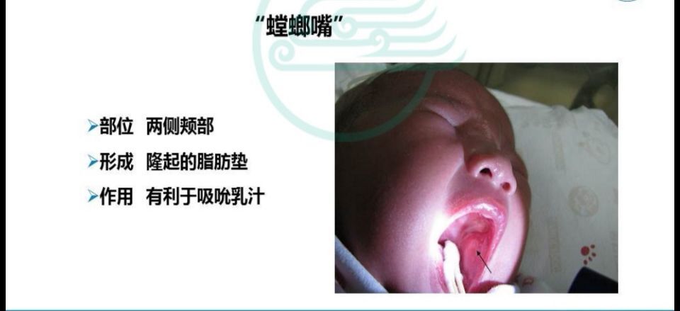 (2)螳螂嘴新生儿上腭中线和齿龈部位,由上皮细胞增生和角化堆积或黏液