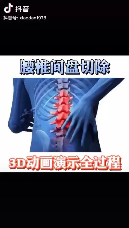 椎间盘突出示意图3D图片