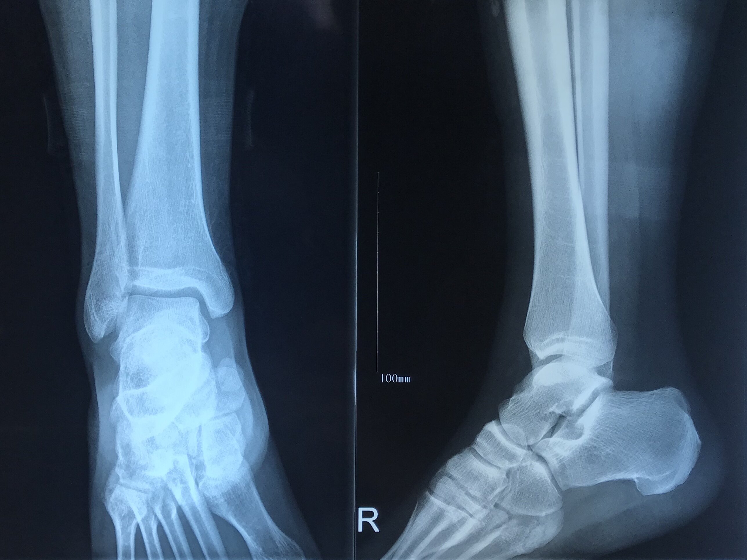 第五跖骨基底部陈旧骨折的认识与处理 跖骨骨折 第五跖骨基底部陈旧骨折的认识与处理 跖骨骨折