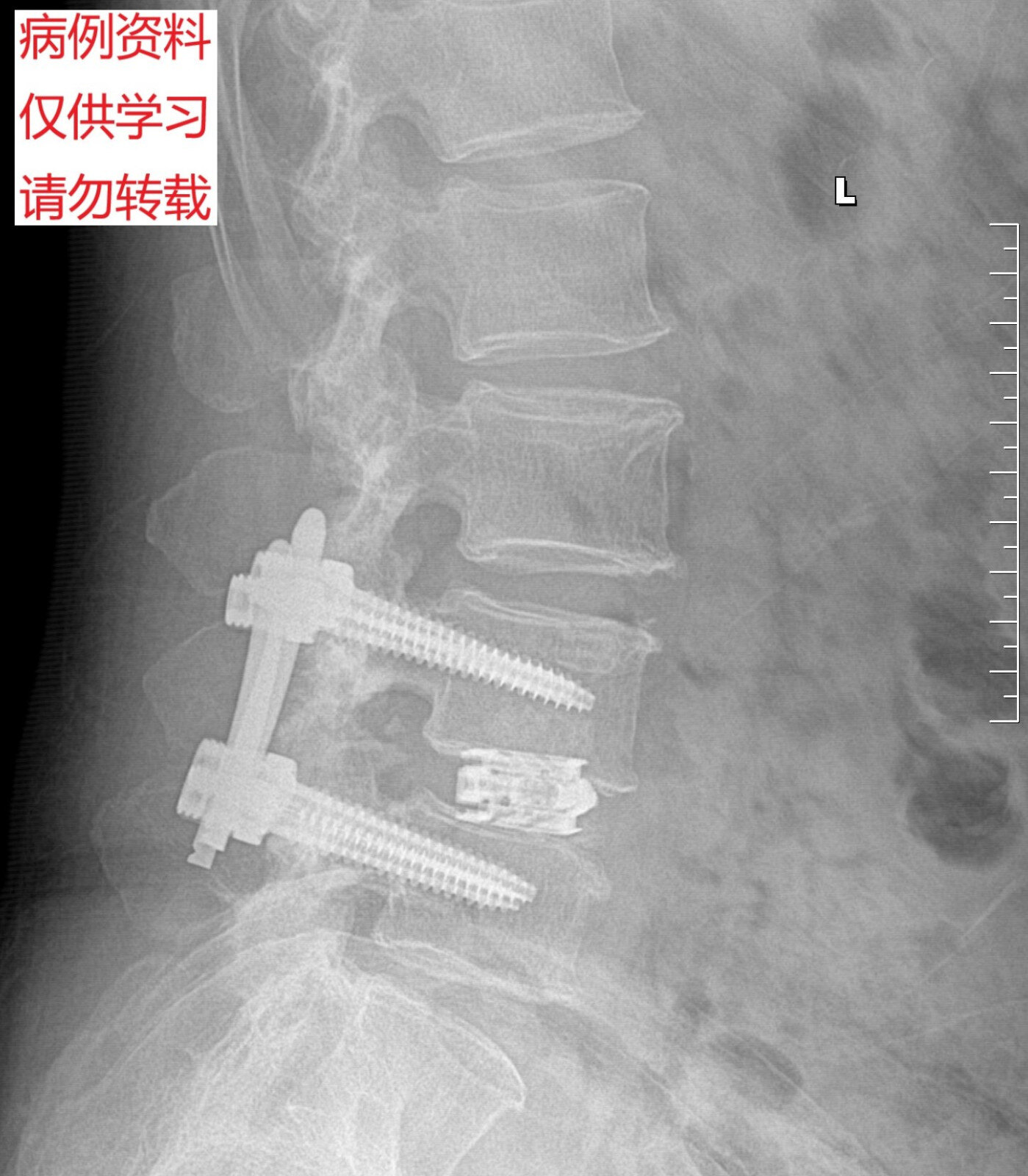 腰椎疾病最新微创治疗方法