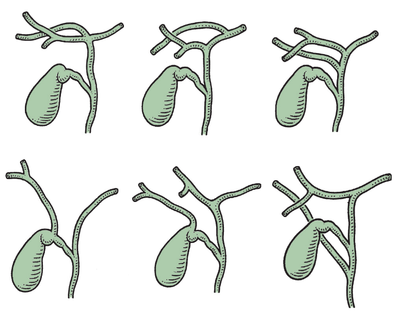 看似简单的胆囊,存在多种解剖变异因为解剖变异,炎症等原因,造成的