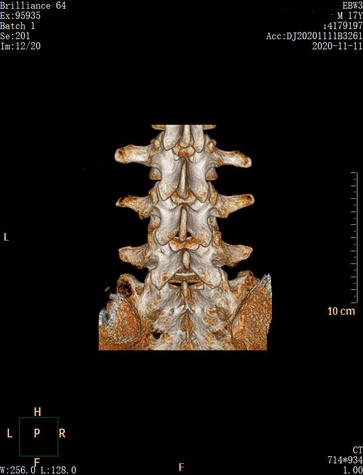 术后ct三维重建显示:左侧l5椎板下缘切除少许.