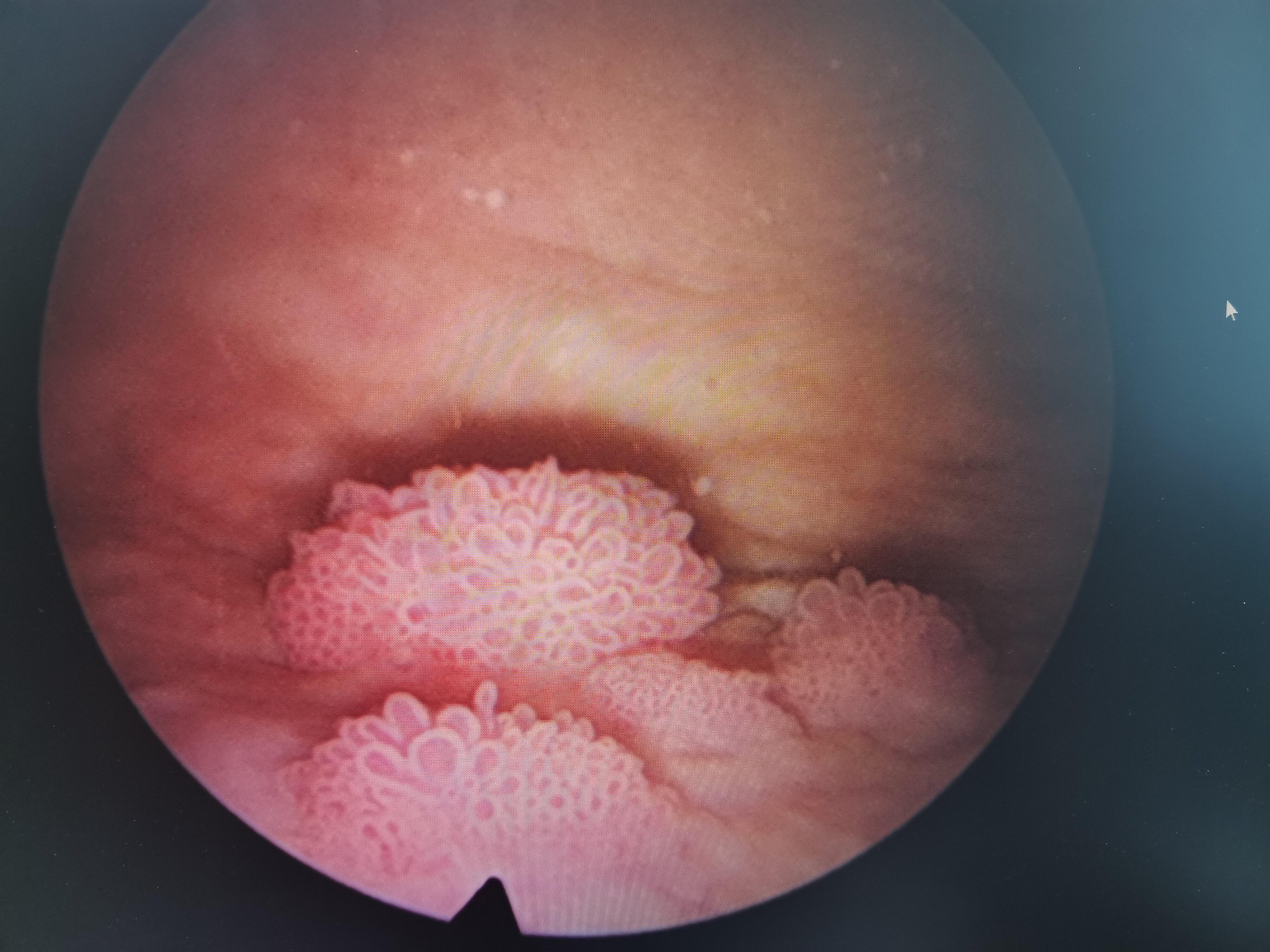 女性膀胱癌图片