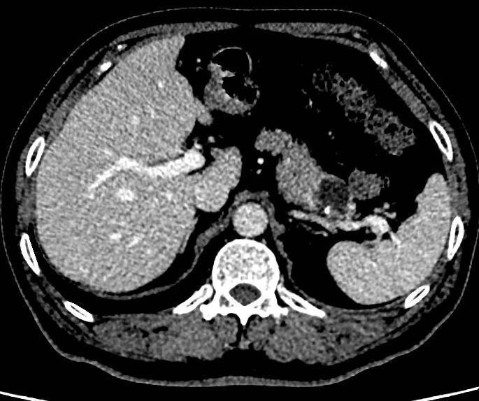 胰腺囊性肿物之浆液性囊腺瘤_胰腺囊肿 好大夫在线