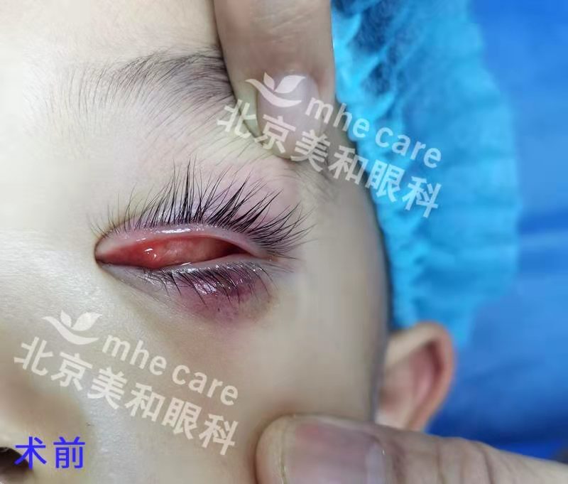 霰粒肿手术前后照片 强脉冲新疗法非手术治疗霰粒肿 霰粒肿 饮食运动 症状 治疗方法