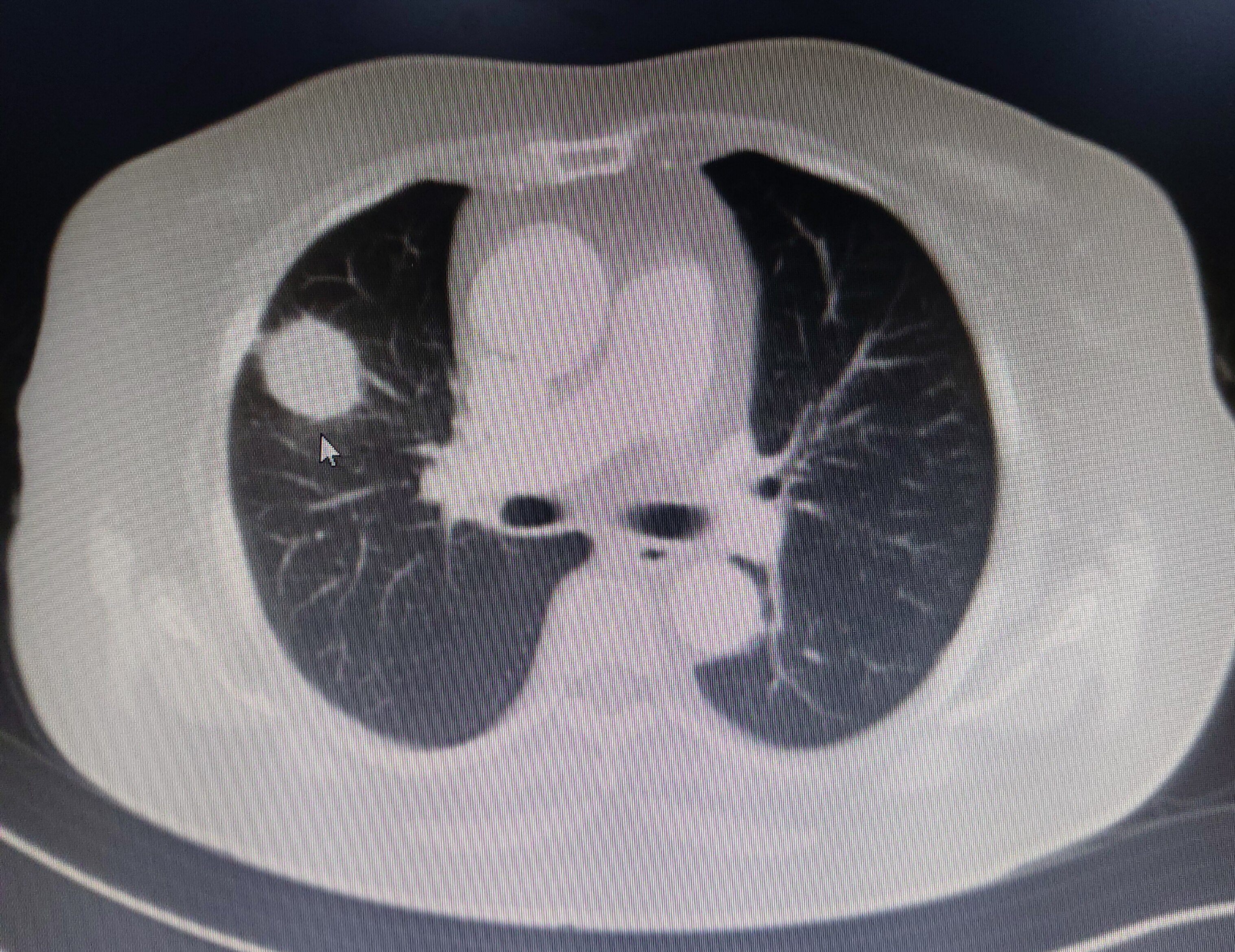 肺肿瘤