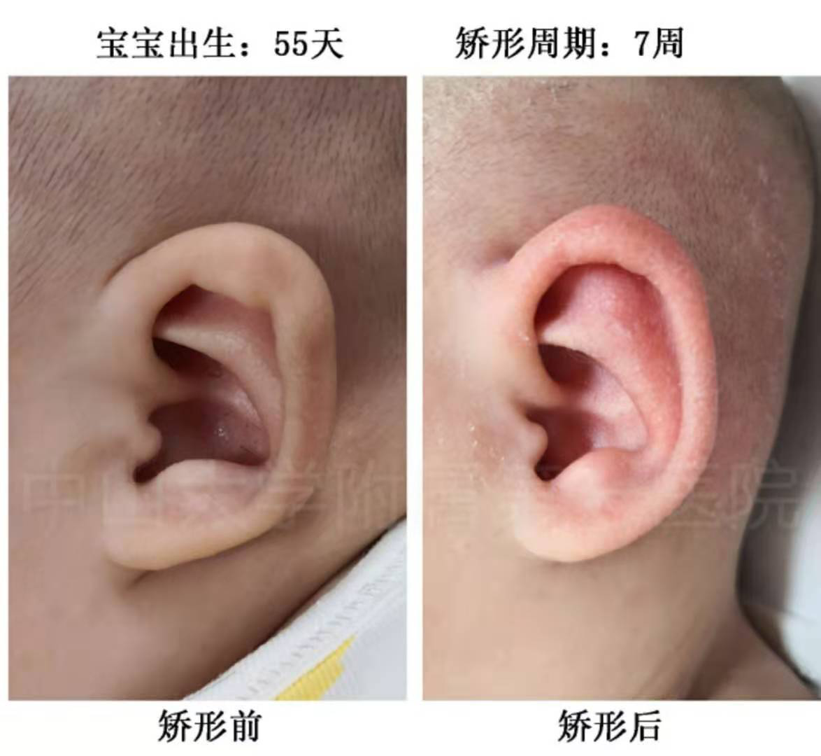 小耳畸形是怎么划分等级的 - 哔哩哔哩